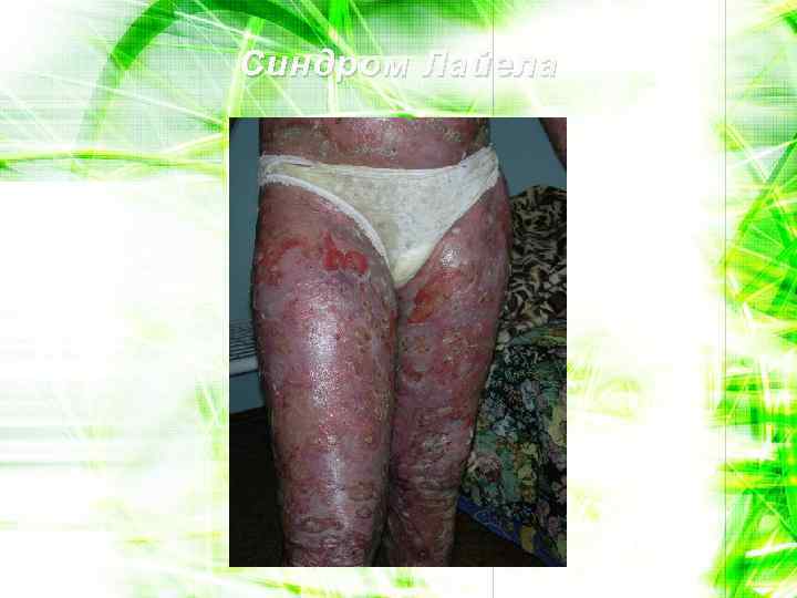 Синдром Лайела 