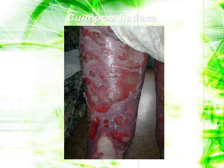 Синдром Лайела 