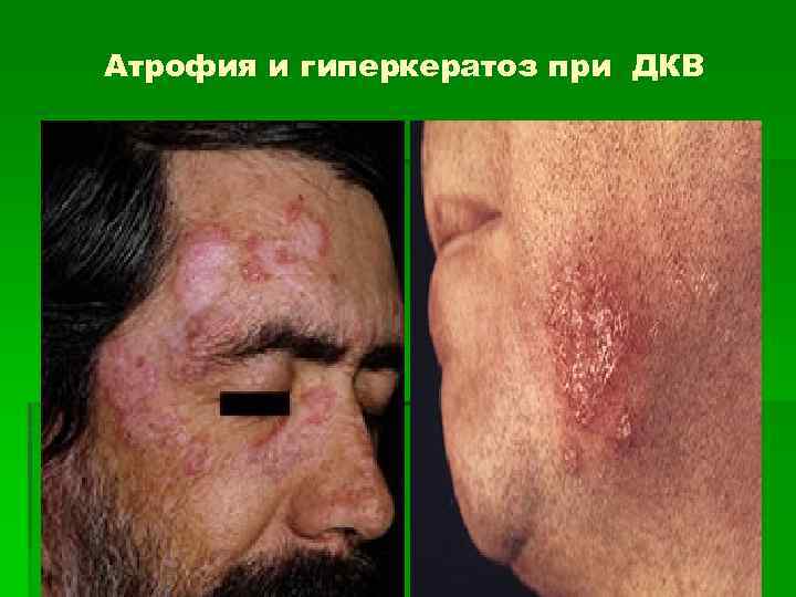 Атрофия и гиперкератоз при ДКВ 