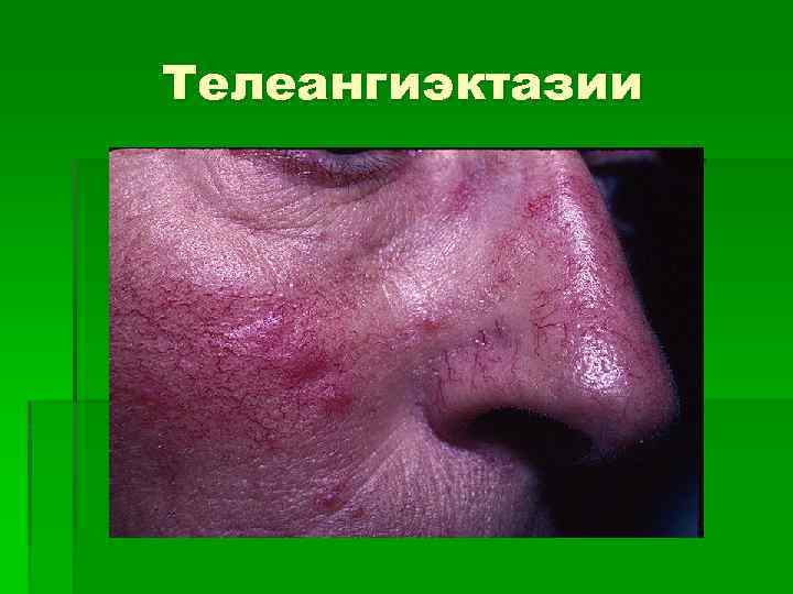 Телеангиэктазии 