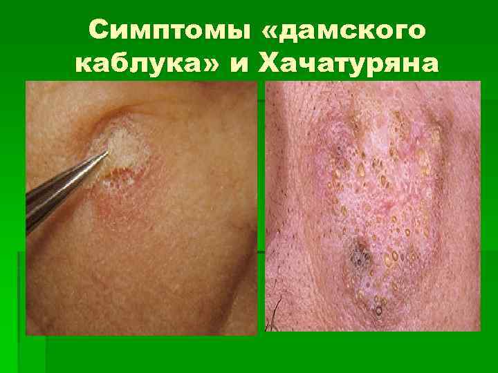 Симптомы «дамского каблука» и Хачатуряна 