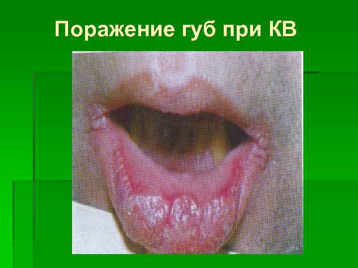 Поражение губ при КВ 