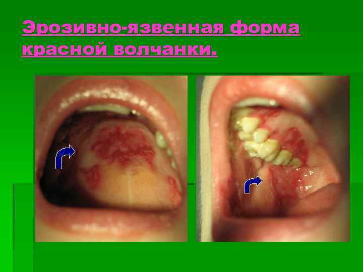 Эрозивно-язвенная форма красной волчанки. 