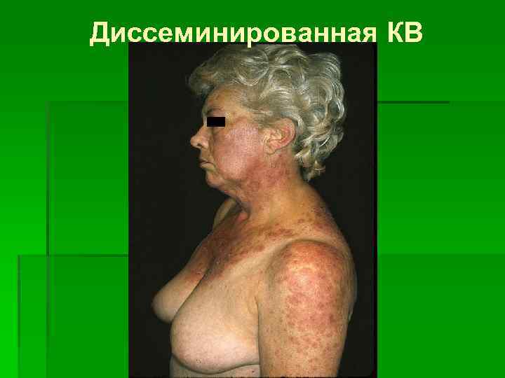 Диссеминированная КВ 