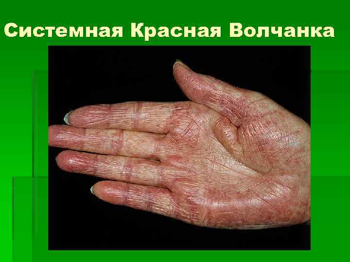 Системная Красная Волчанка 