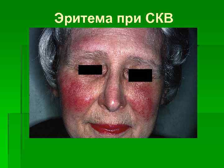 Эритема при СКВ 