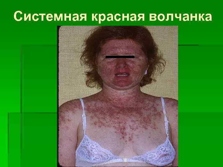 Системная красная волчанка 