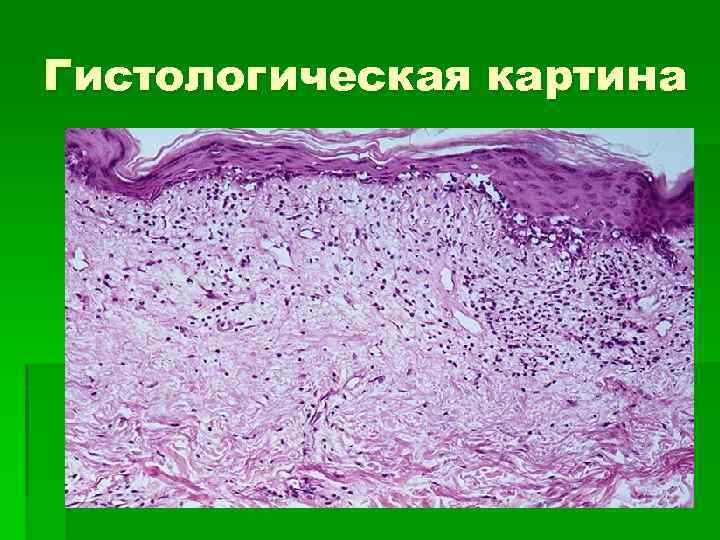 Гистологическая картина 