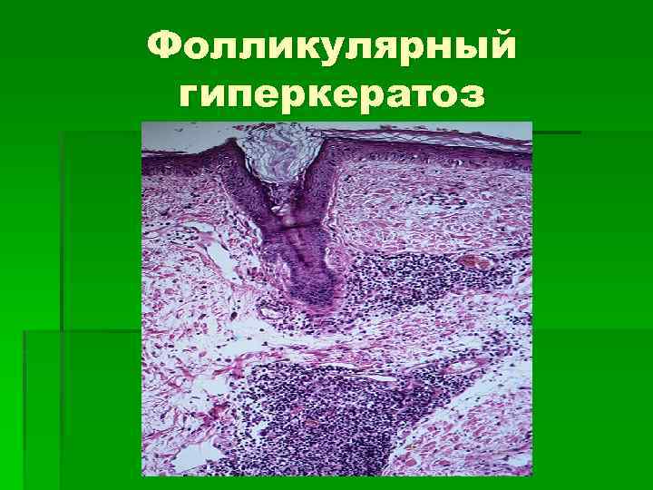 Фолликулярный гиперкератоз 