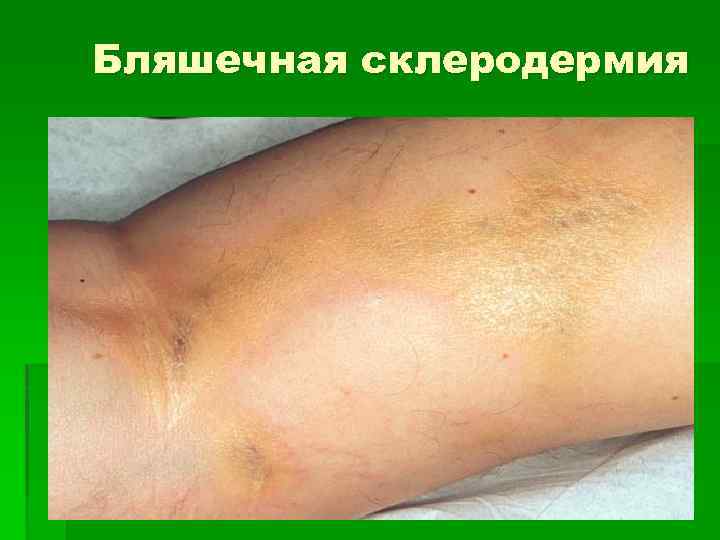Бляшечная склеродермия 