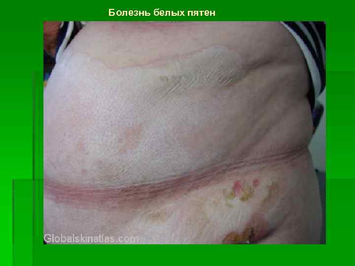 Болезнь белых пятен 