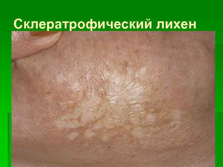 Склератрофический лихен 