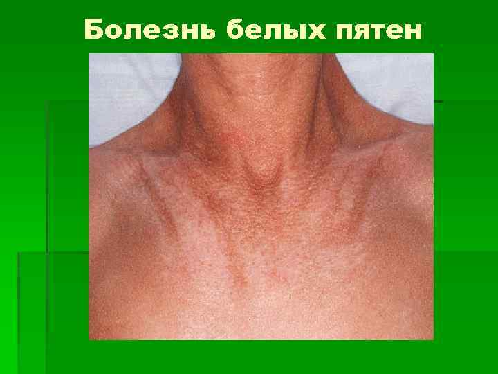 Болезнь белых пятен 