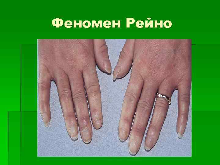 Феномен Рейно 