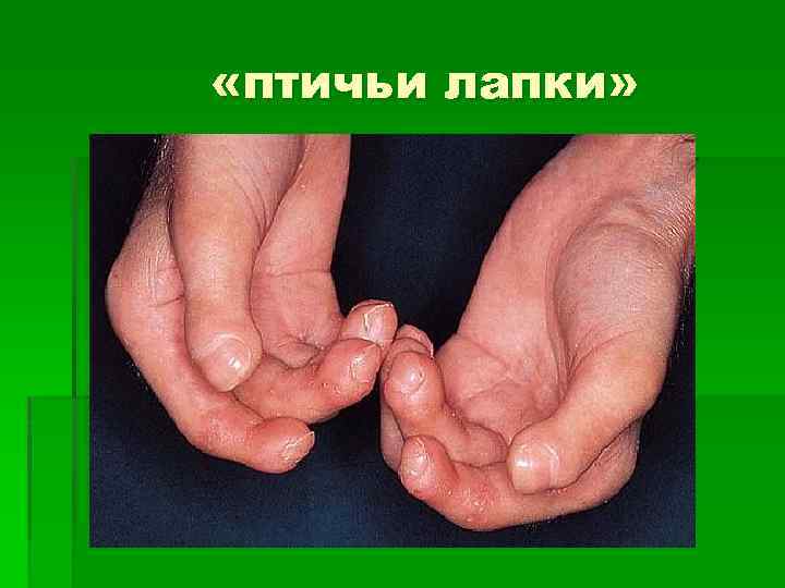  «птичьи лапки» 