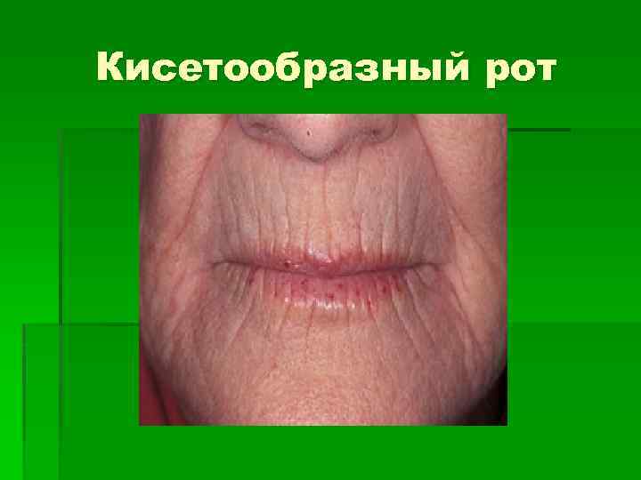 Кисетообразный рот 