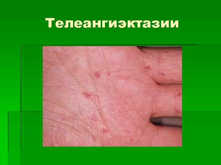 Телеангиэктазии 