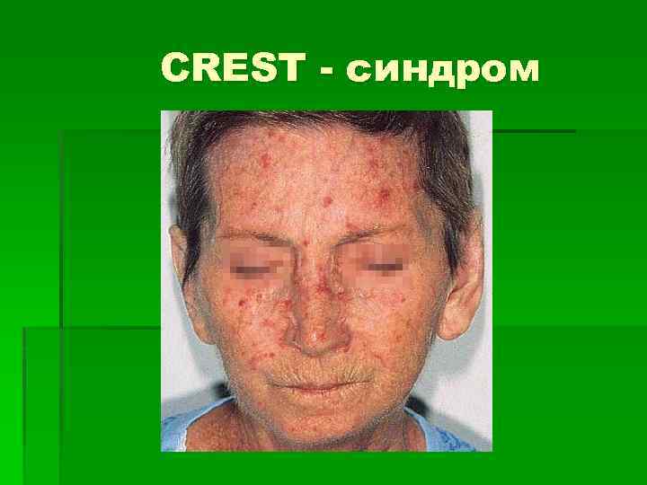 CREST - синдром 