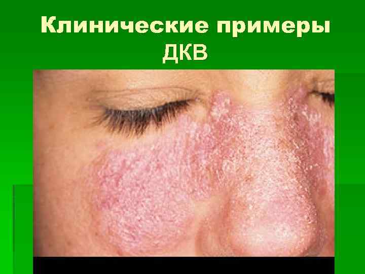 Клинические примеры ДКВ 