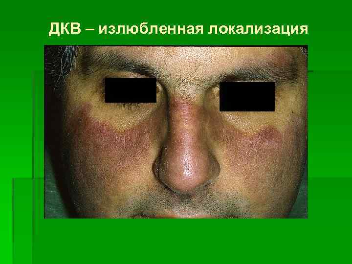 ДКВ – излюбленная локализация 