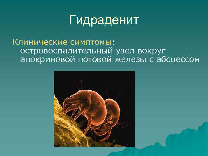 Гидраденит Клинические симптомы: островоспалительный узел вокруг апокриновой потовой железы с абсцессом 