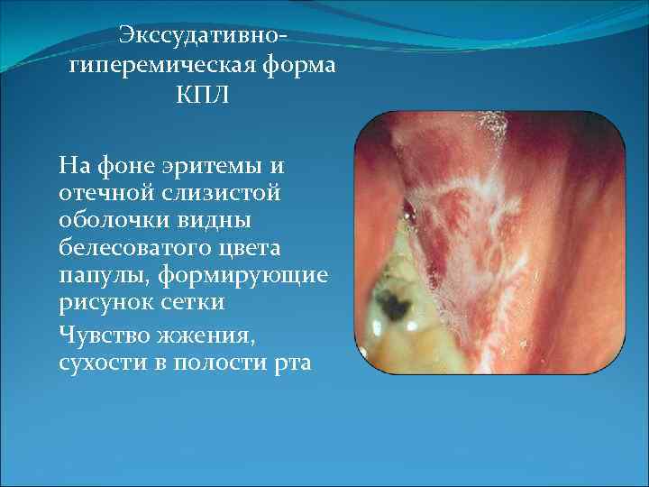 Экссудативногиперемическая форма КПЛ На фоне эритемы и отечной слизистой оболочки видны белесоватого цвета папулы,