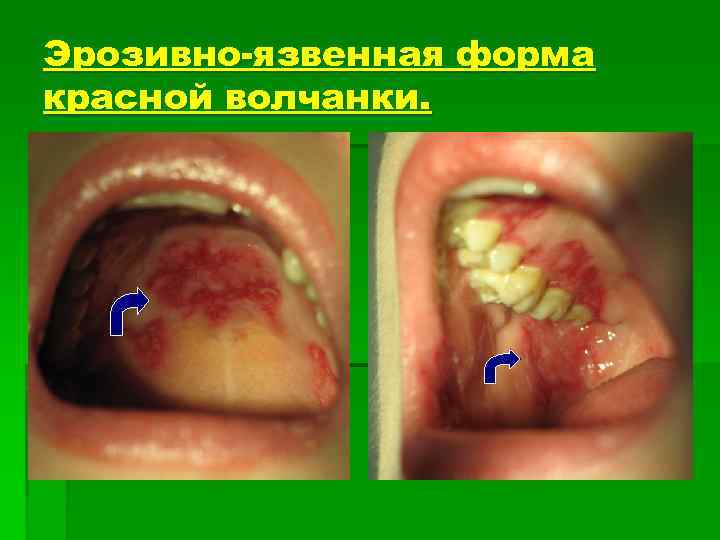 Эрозивно-язвенная форма красной волчанки. 