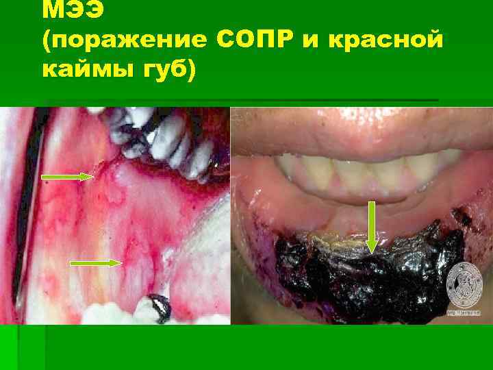 МЭЭ (поражение СОПР и красной каймы губ) 