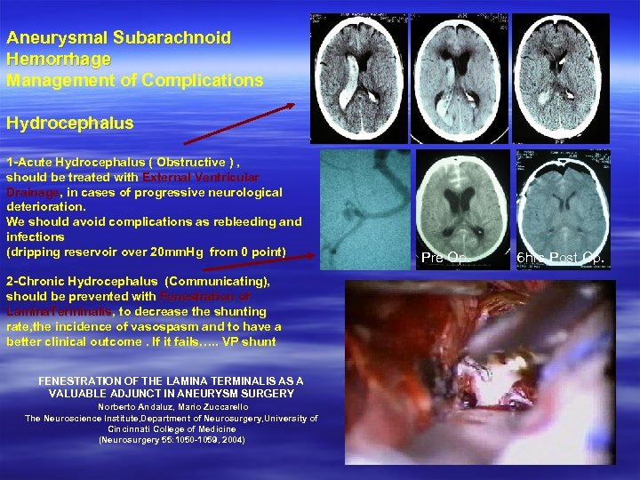 Aneurysmal Subarachnoid Hemorrhage Management of Complications Hydrocephalus 1 -Acute Hydrocephalus ( Obstructive ) ,
