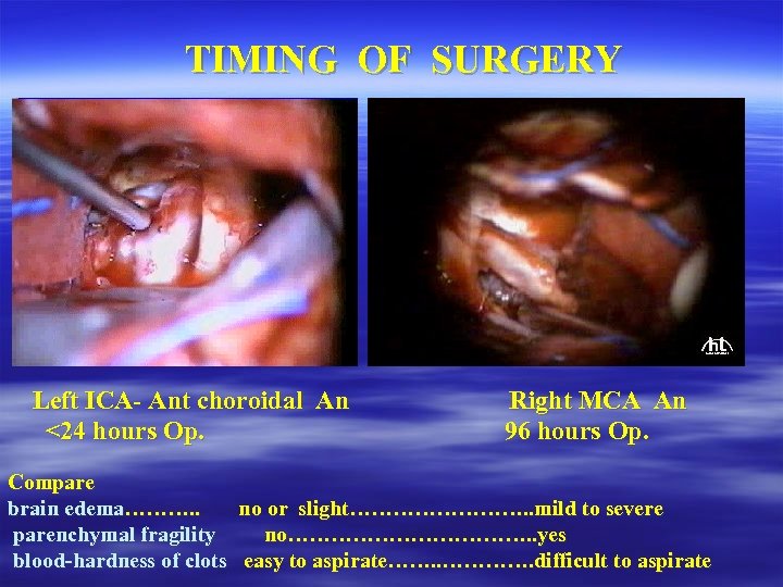 TIMING OF SURGERY Left ICA- Ant choroidal An <24 hours Op. Right MCA An