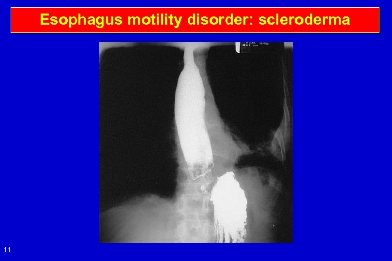 Esophagus motility disorder: scleroderma 11 