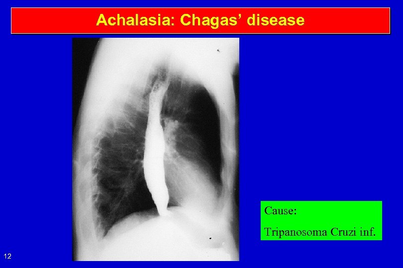 Achalasia: Chagas’ disease Cause: Tripanosoma Cruzi inf. 12 