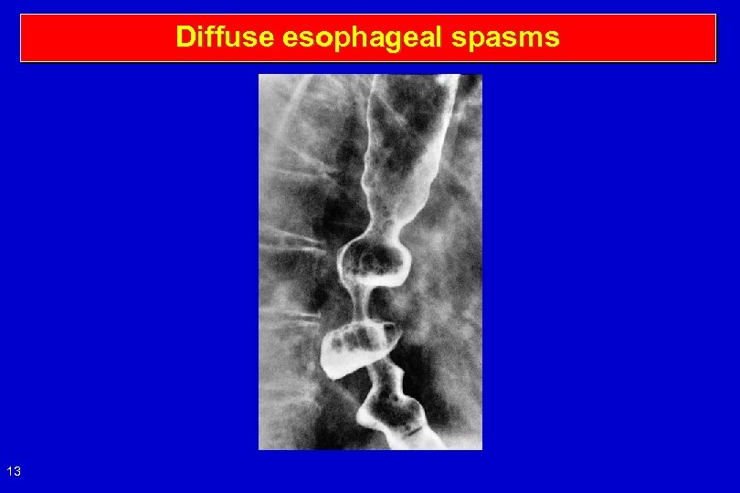 Diffuse esophageal spasms 13 