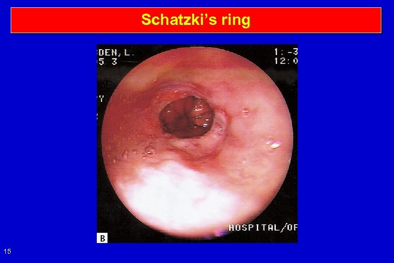 Schatzki’s ring 15 