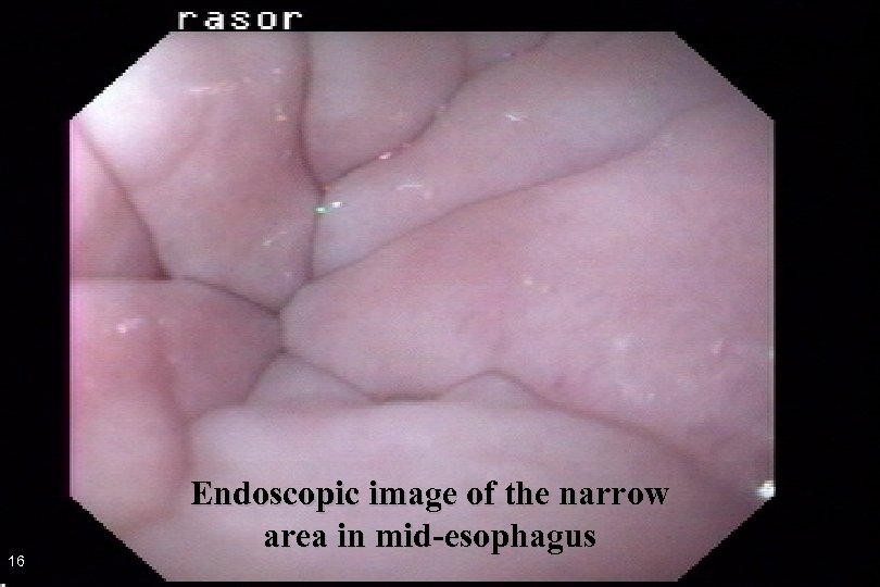 16 Endoscopic image of the narrow area in mid-esophagus 