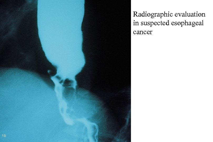 Radiographic evaluation in suspected esophageal cancer 19 