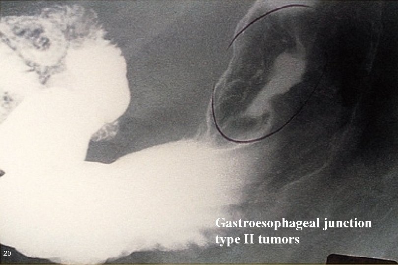 Gastroesophageal junction type II tumors 20 