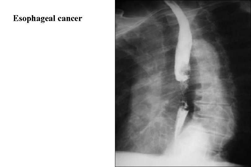 Esophageal cancer 21 