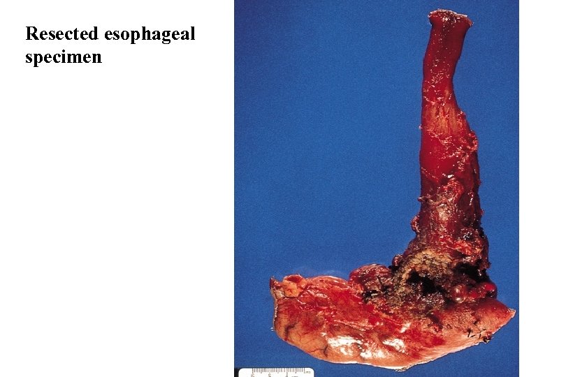 Resected esophageal specimen 25 