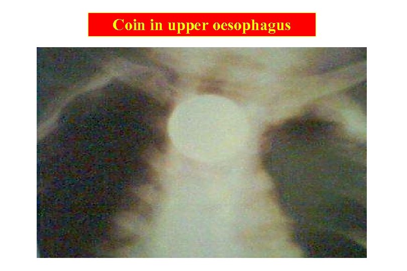 Coin in upper oesophagus 27 