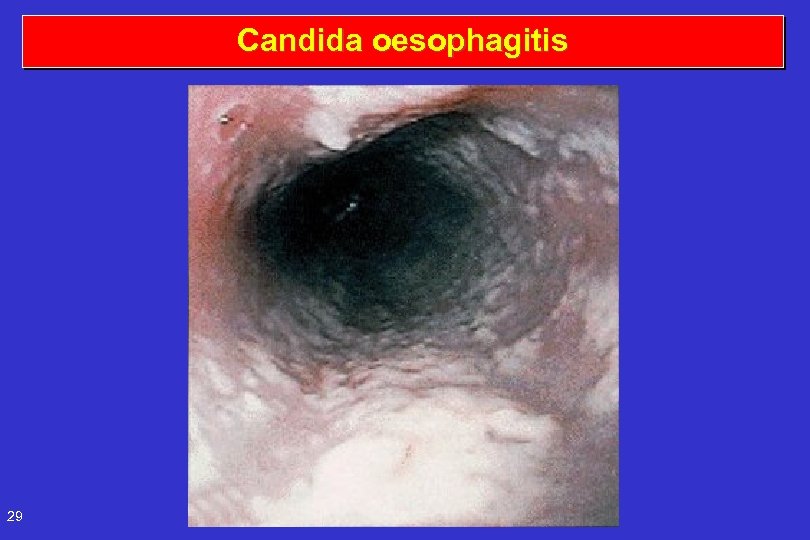 Candida oesophagitis 29 