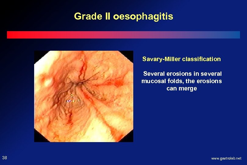 Grade II oesophagitis Savary-Miller classification Several erosions in several mucosal folds, the erosions can