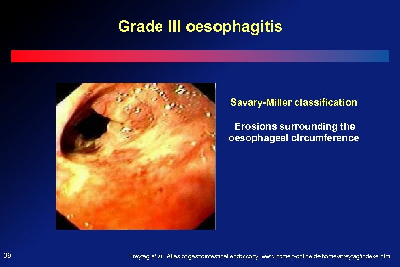 Grade III oesophagitis Savary-Miller classification Erosions surrounding the oesophageal circumference 39 Freytag et al.