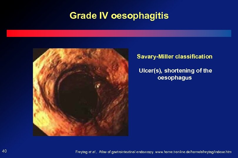 Grade IV oesophagitis Savary-Miller classification Ulcer(s), shortening of the oesophagus 40 Freytag et al.