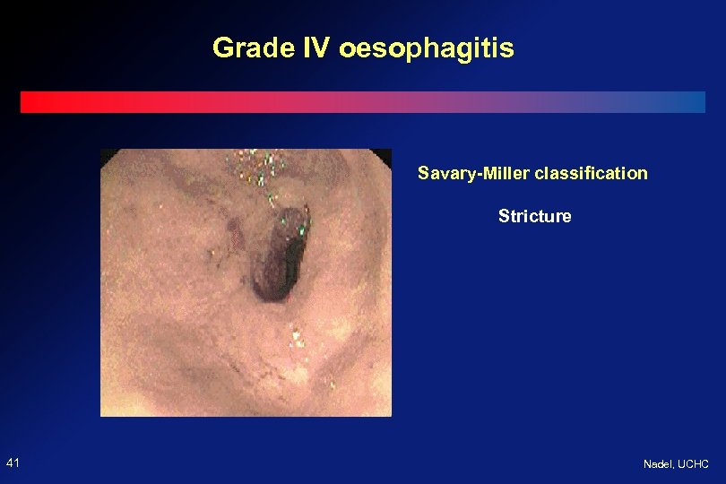 Grade IV oesophagitis Savary-Miller classification Stricture 41 Nadel, UCHC 