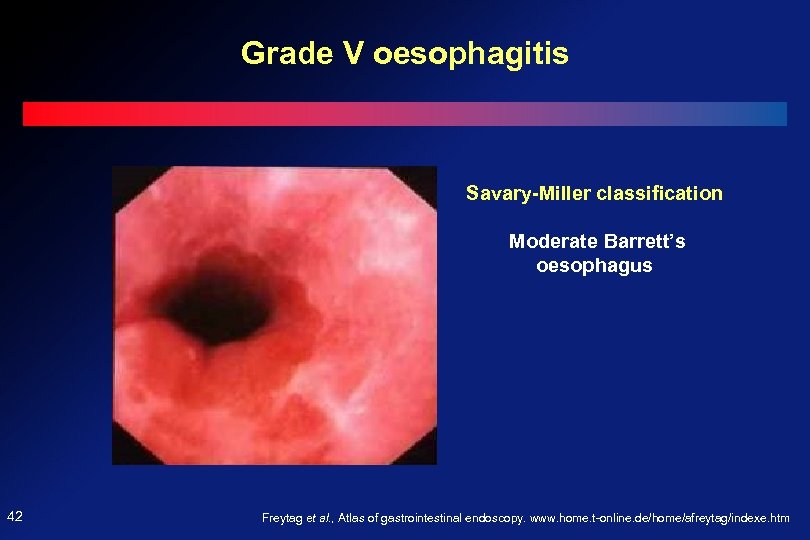 Grade V oesophagitis Savary-Miller classification Moderate Barrett’s oesophagus 42 Freytag et al. , Atlas