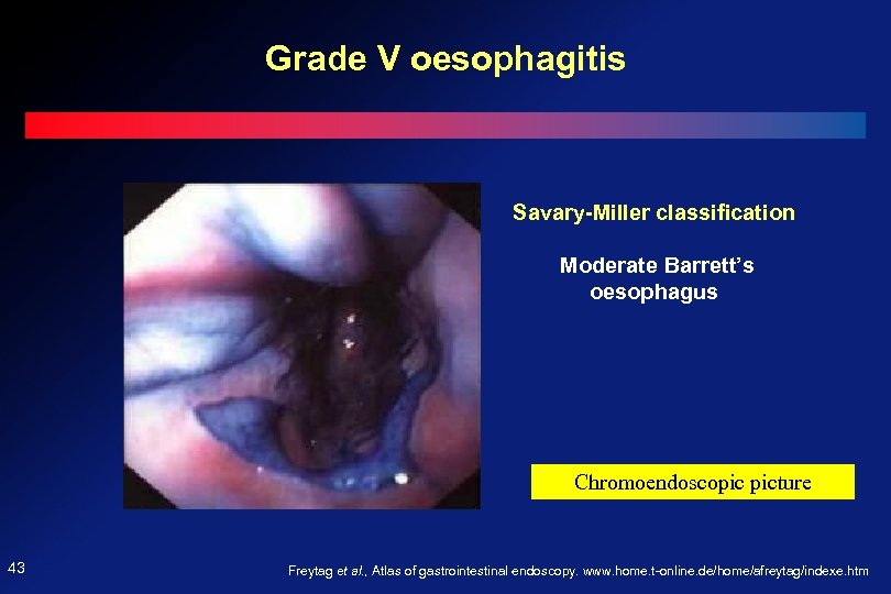 Grade V oesophagitis Savary-Miller classification Moderate Barrett’s oesophagus Chromoendoscopic picture 43 Freytag et al.