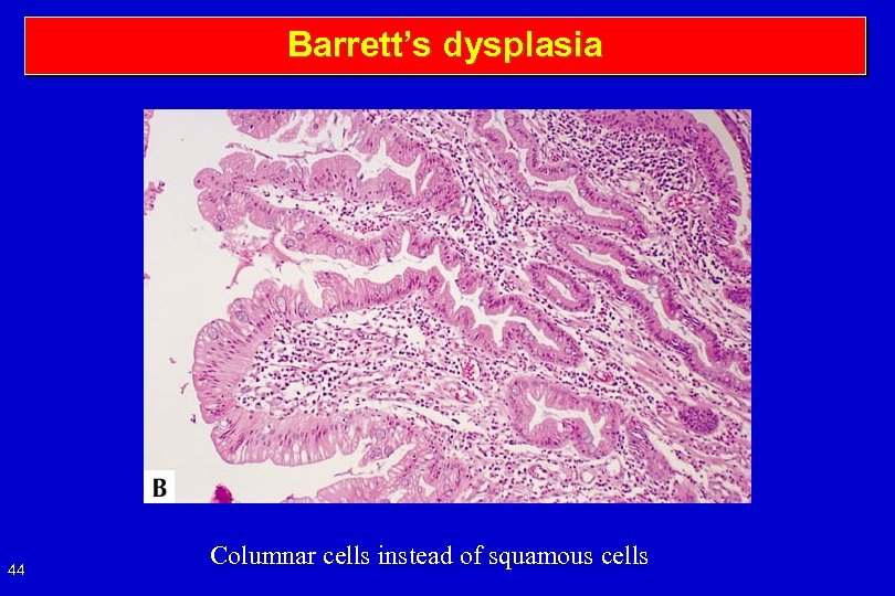 Barrett’s dysplasia 44 Columnar cells instead of squamous cells 