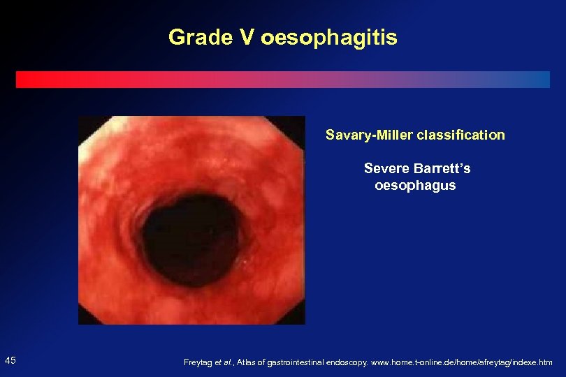 Grade V oesophagitis Savary-Miller classification Severe Barrett’s oesophagus 45 Freytag et al. , Atlas