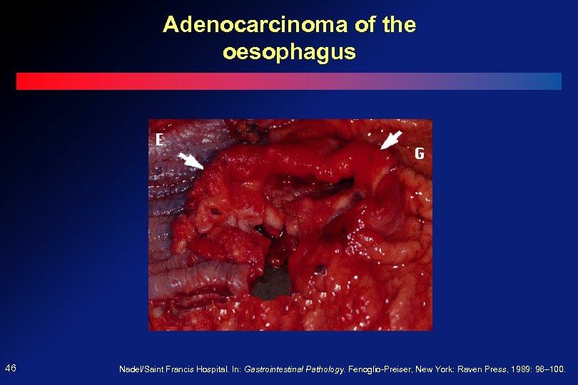 Adenocarcinoma of the oesophagus 46 Nadel/Saint Francis Hospital. In: Gastrointestinal Pathology. Fenoglio-Preiser, New York: